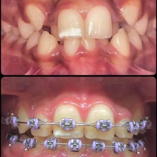 Ortodontia (aparelho)