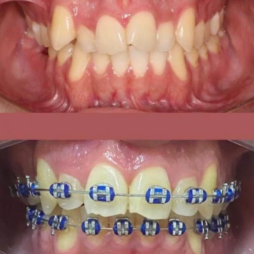 Ortodontia (aparelho)