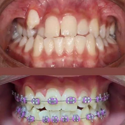 Ortodontia (aparelho)